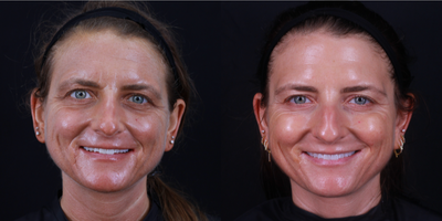 Dysport before and after photo