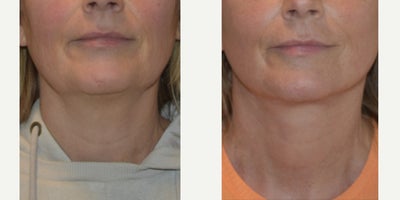 Facial Fat Transfer before and after photo