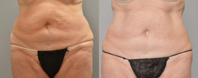 Liposuction before and after photo