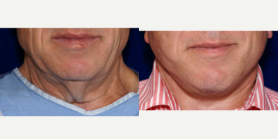 Neck Lift before and after photo