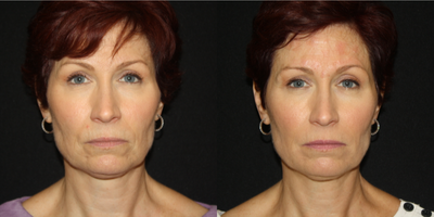Restylane before and after photo