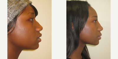 African American Rhinoplasty before and after photo