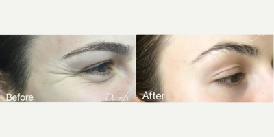 Botox before and after photo