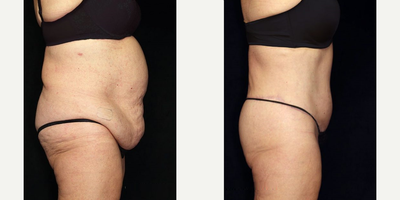 Body Lift before and after photo
