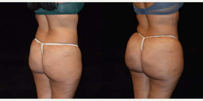 Brazilian Butt Lift before and after photo