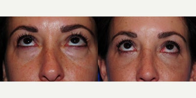 Eyelid Surgery before and after photo