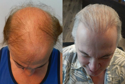 Hair Transplant before and after photo