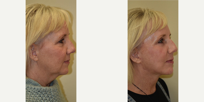 Neck Lift before and after photo