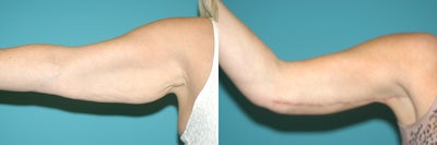 Arm Lift before and after photo