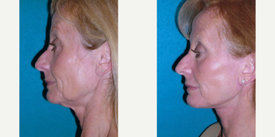 Facelift before and after photo