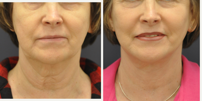 Facelift before and after photo