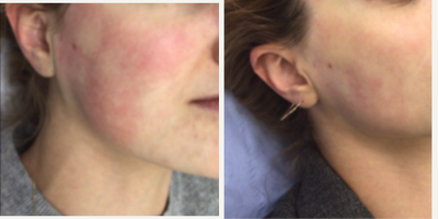 IPL before and after photo