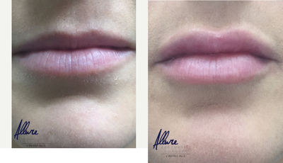 Lip Fillers before and after photo