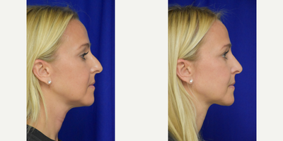 Rhinoplasty before and after photo