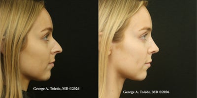Rhinoplasty before and after photo