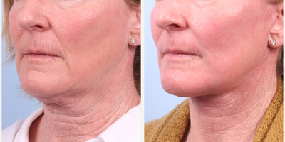 Chemical Peel before and after photo