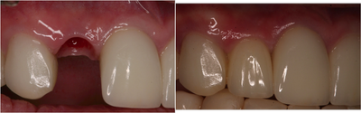 Smile Makeover before and after photo