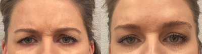 Xeomin before and after photo