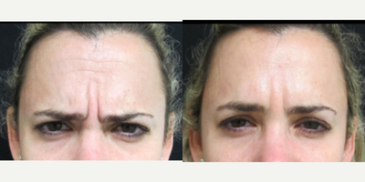Botox before and after photo
