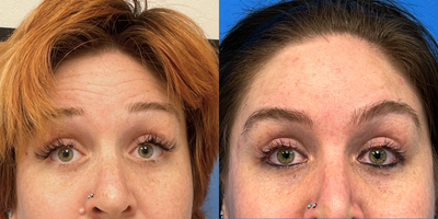 Botox before and after photo