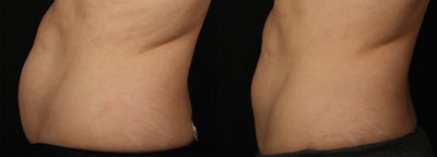 CoolSculpting before and after photo