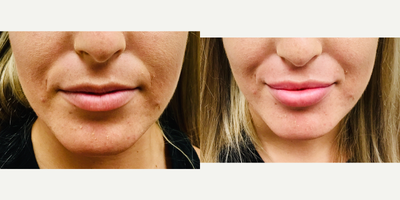 Dermal Fillers before and after photo