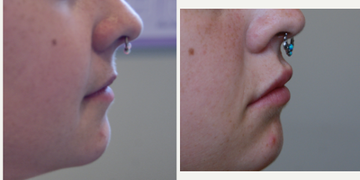 Lip Fillers before and after photo