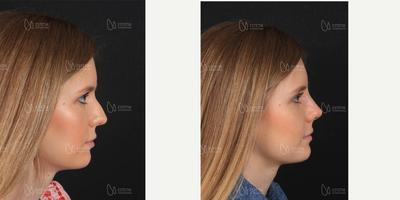 Nonsurgical Nose Job before and after photo