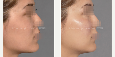 Cheek Fillers before and after photo
