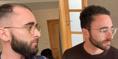 Hair Transplant before and after photo