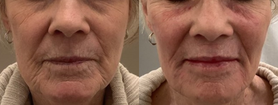 Restylane Defyne before and after photo