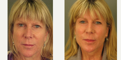 CO2 Laser before and after photo