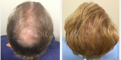 Hair Transplant before and after photo