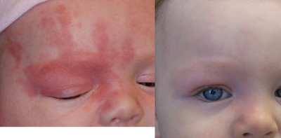 Vbeam before and after photo