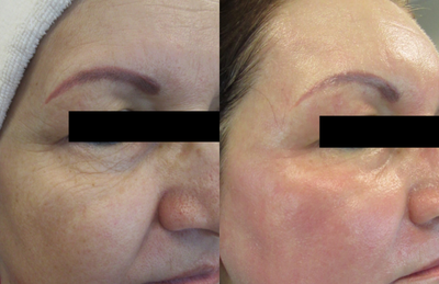 CO2 Laser before and after photo