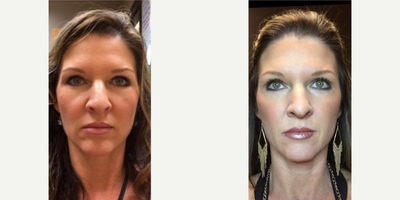Juvederm before and after photo