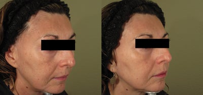 Laser Peel before and after photo