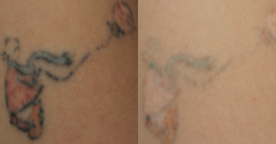 Tattoo Removal before and after photo
