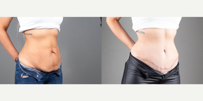 Tummy Tuck before and after photo