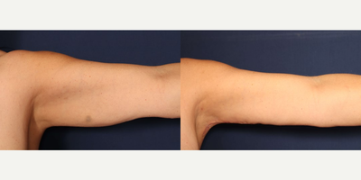 Arm Lift before and after photo