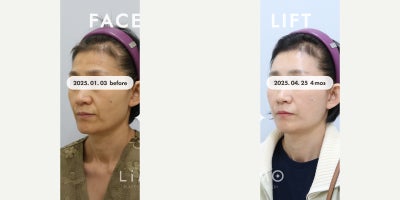 Brow Lift before and after photo
