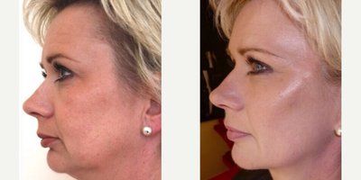 Facelift before and after photo