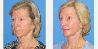 Facelift before and after photo