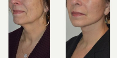 Facial Fat Transfer before and after photo
