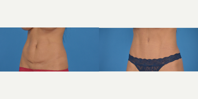 Tummy Tuck before and after photo