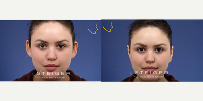 Ear Surgery before and after photo