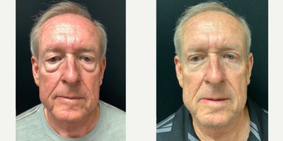 Eyelid Surgery before and after photo