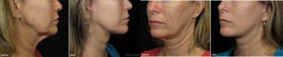 Facelift before and after photo