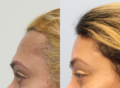 Forehead Reduction before and after photo
