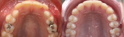 Smile Makeover before and after photo